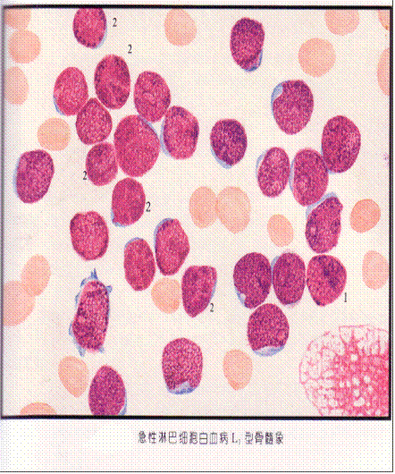 图1急性淋巴细胞白血病