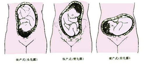 三:胎产式,胎先露,胎方位 1.胎产式(详细请见图)